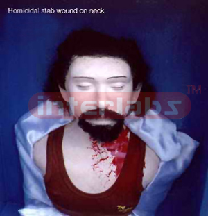 Homicidal stab wound on neck